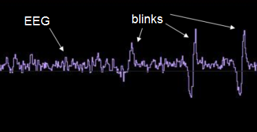 EEG vs Blinks Amplitude